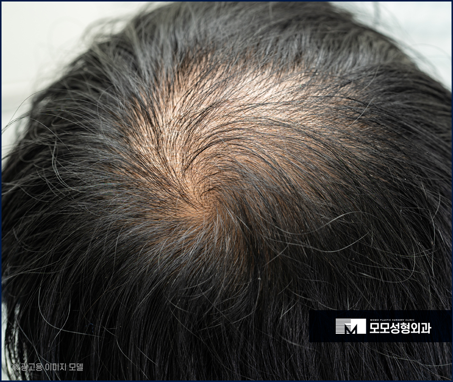 남자 앞머리 탈모 M자 라인 깊어짐이 보인다면 관련 이미지 12