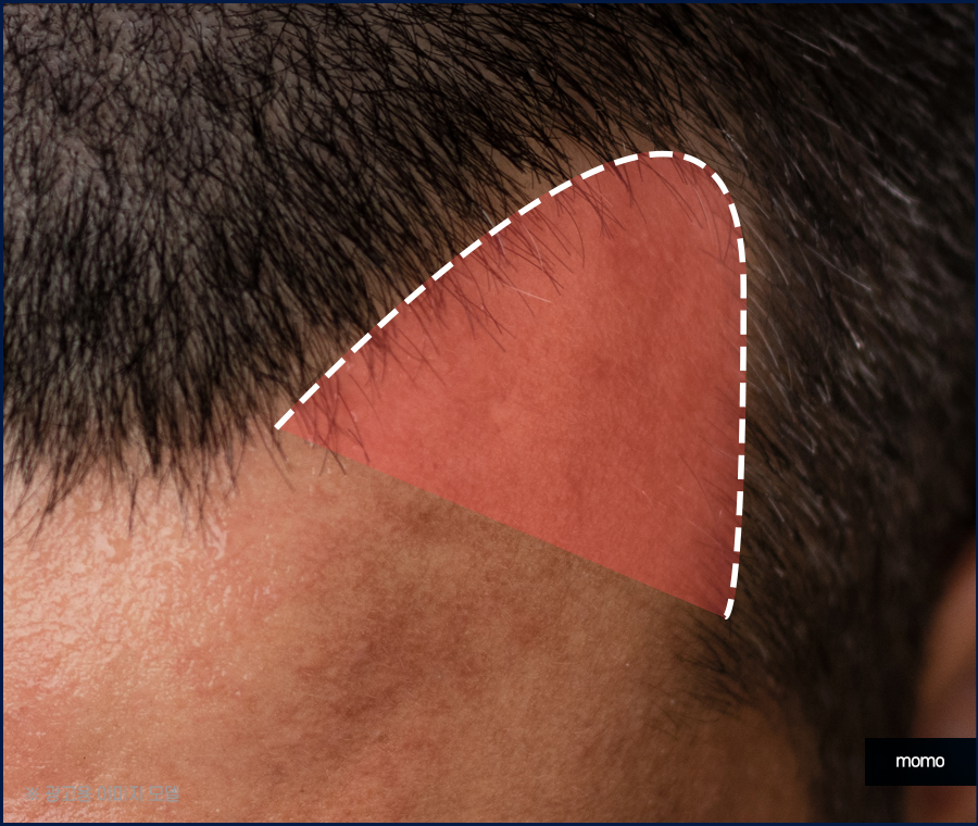 헤어라인모발이식비용 생착률을 높여가면서 관련 이미지 3