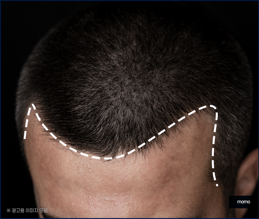 m자탈모초기 빠른 대처를 이뤄낸다면 관련 이미지 7