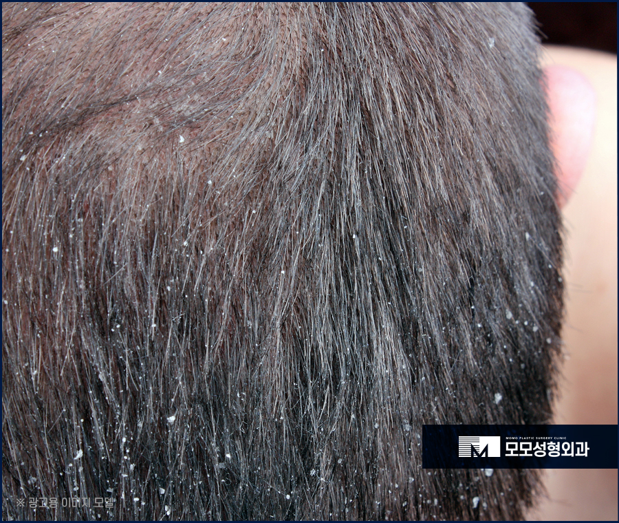 머리안감으면탈모 나타나게 될까 관련 이미지 2