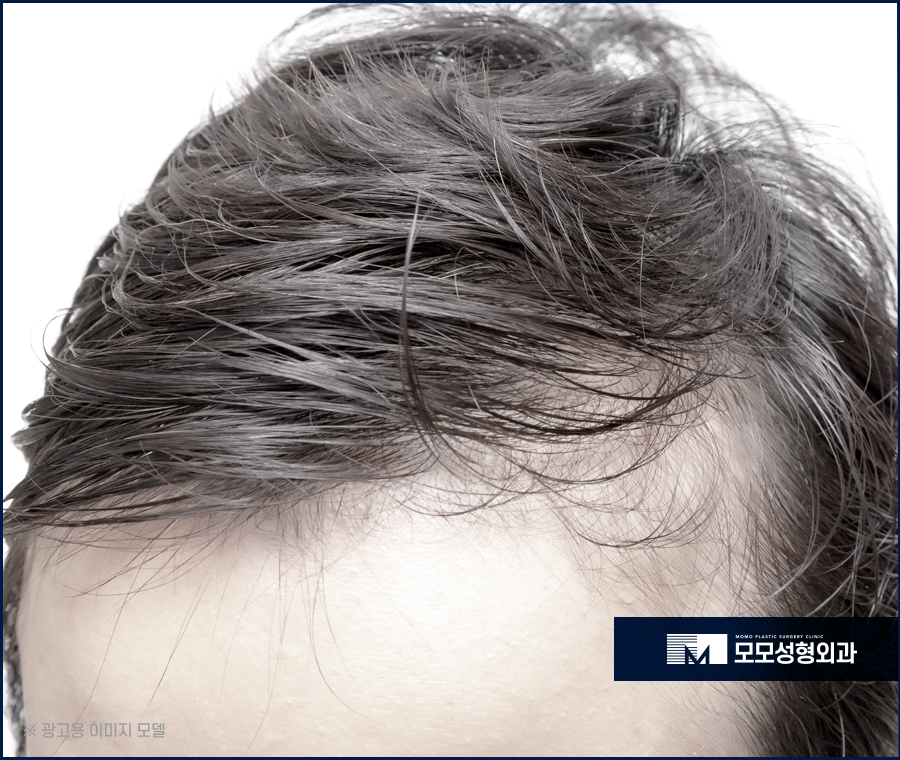 모발이식 6개월 차 변화와 유의할 점에 대해서 관련 이미지 2