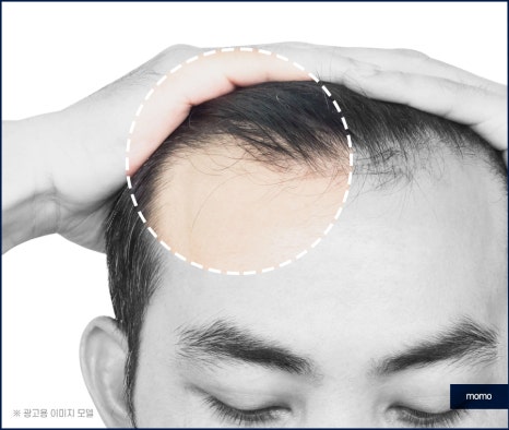 모발이식3000모비용 차이나는 이유 관련 이미지 3