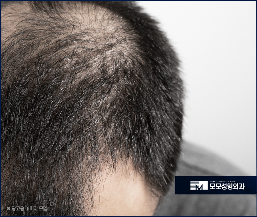 체모 이식 부위별 특성 고려해서 자연스런 결과로 관련 이미지 4