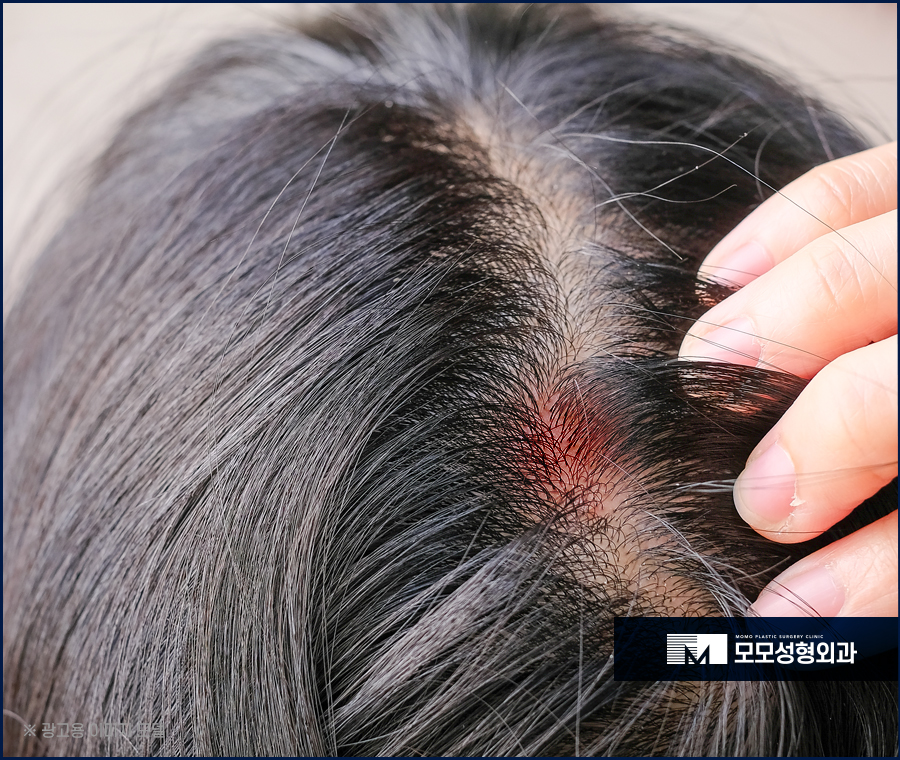 지루성두피염증상 어떤 것들이 있는지 관련 이미지 2