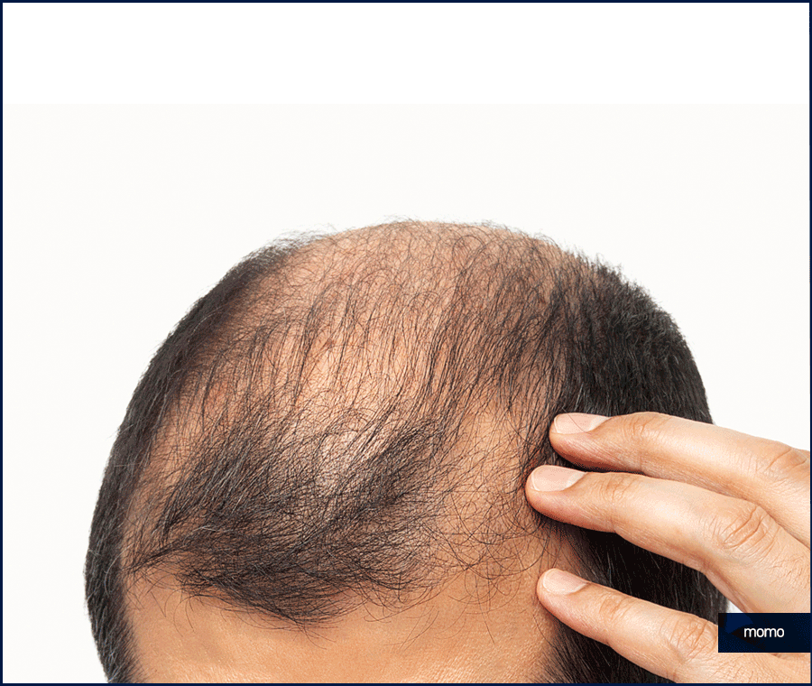 탈모약 복용시간의 중요성 및 주의사항 정리 관련 이미지 4