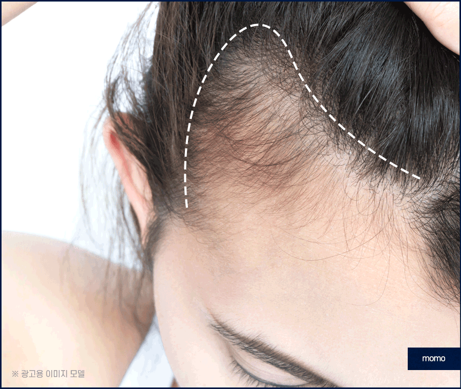 모발이식 2000모 자연스러운 커버 결과 정도는? 관련 이미지 9