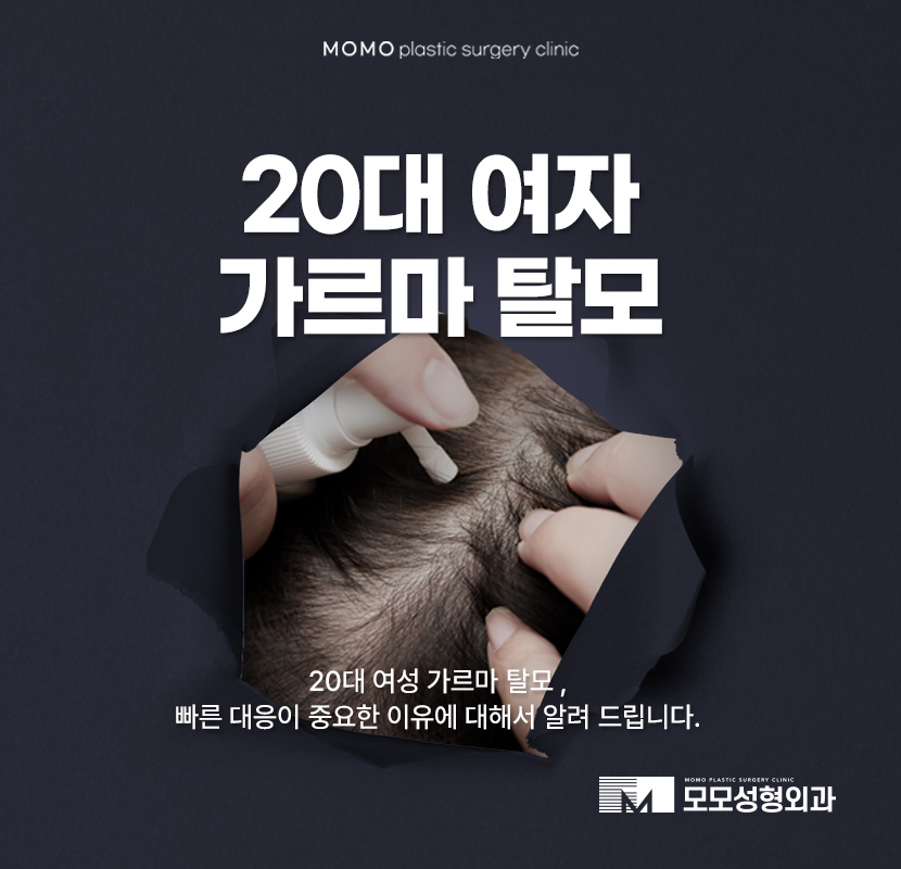 20대 여자 가르마 탈모 빠른 대응이 중요한 이유 관련 이미지 1