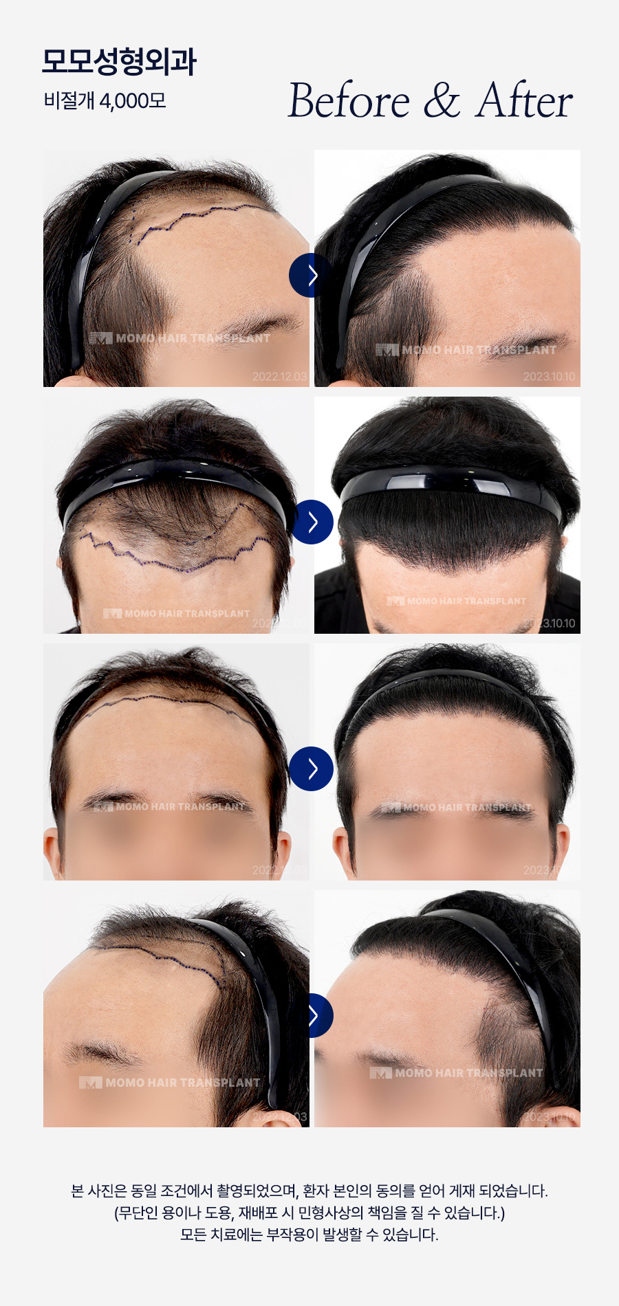 압구정역 모발이식 방법 및 생착률을 높이는 팁 관련 이미지 14