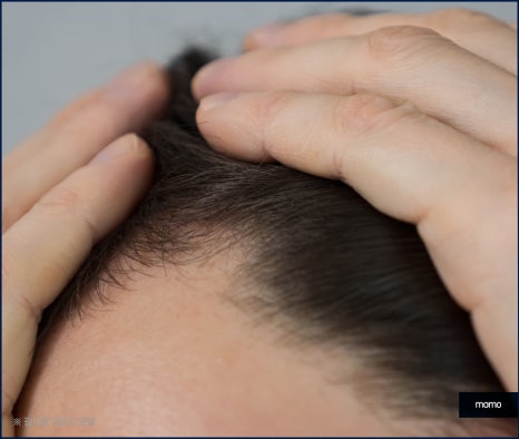 여자 m자 이마 헤어라인 모발이식으로 교정 관련 이미지 5