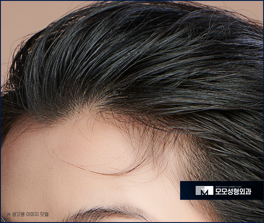 여자M자이마탈모 개인맞춤 진행의 중요성에 대하여 관련 이미지 2