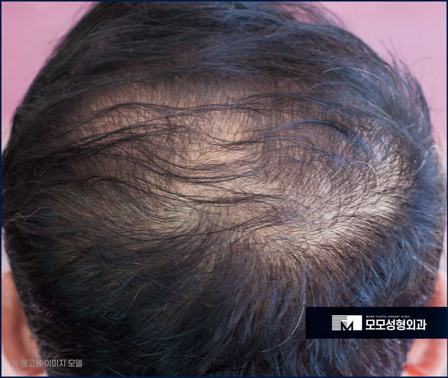 바르는미녹시딜효과 호전에 도움이 될까 관련 이미지 2