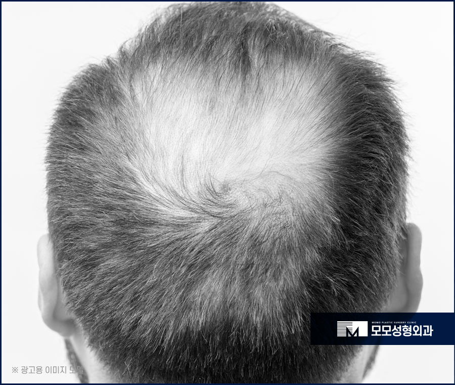 정수리모발이식비용 얼굴 이미지를 고려하며 관련 이미지 4