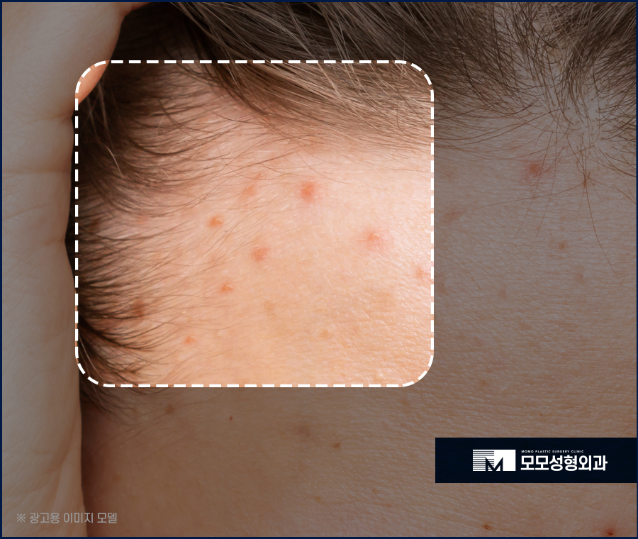 우습게 여기지 말아야 할 헤어라인 뾰루지 관련 이미지 3