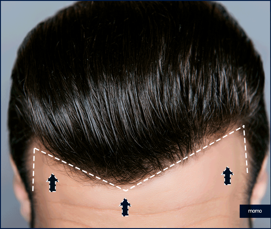 엠자탈모 약 진단과 처방으로 효과보기 위한 관련 이미지 5