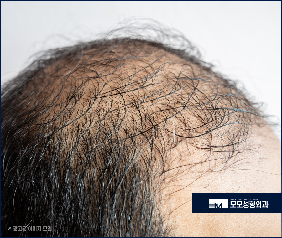 두피모낭염 증세와 해결 방법에 대해 관련 이미지 7