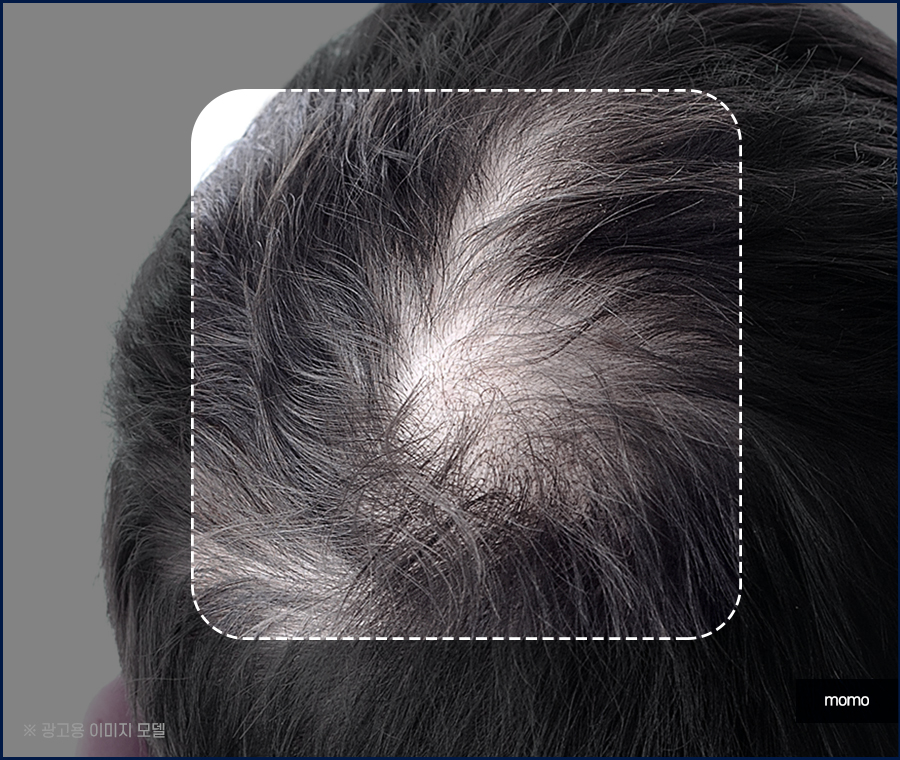 모발이식 절개 비절개 방법을 비교 분석해 가며 관련 이미지 4