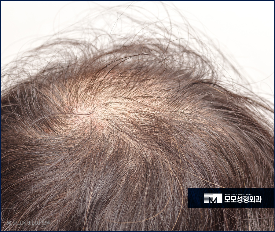 모발이식절개비절개 방식의 차이점 관련 이미지 3
