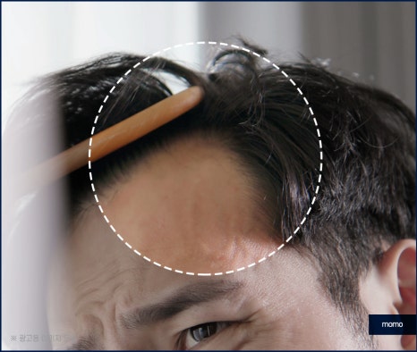 압구정 모발이식 외모 변화를 희망한다면 관련 이미지 7