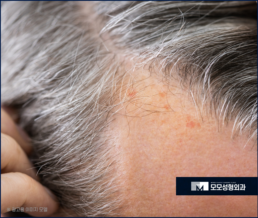 헤어라인좁쌀여드름 생성 원인과 해결법 관련 이미지 6