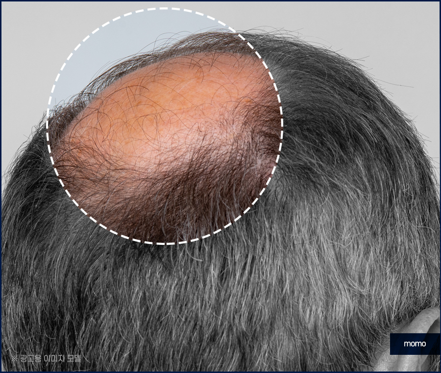 남자 가르마 탈모 고민을 끝내기 위한 방안은 관련 이미지 6