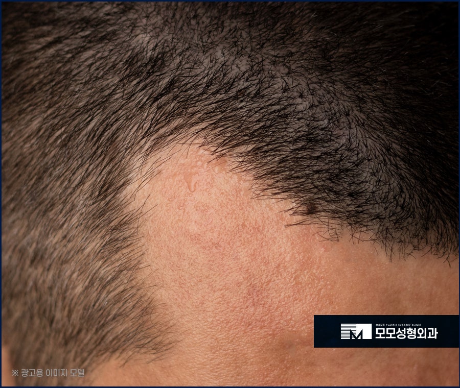 엠자이마 촘촘하게 채워 자연스럽게 보강하는 관련 이미지 4