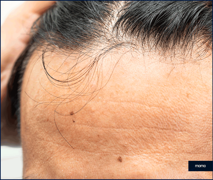 모발이식전후 확인 중이라면 꼭 체크할 핵심 요소 관련 이미지 7
