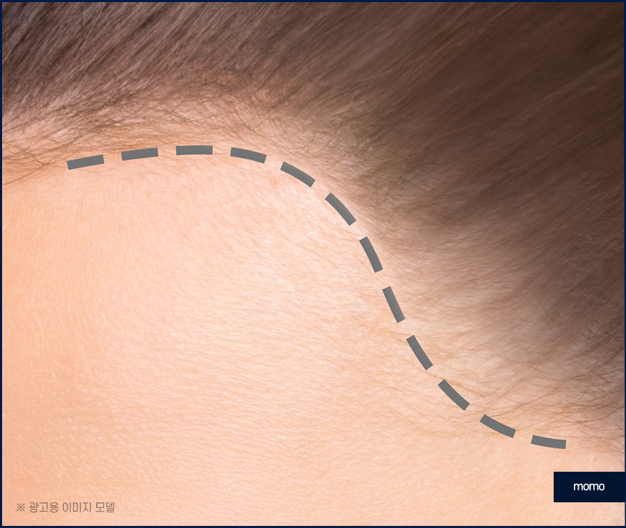 여성 모발이식 자연스러운 변화를 만드는 관련 이미지 7