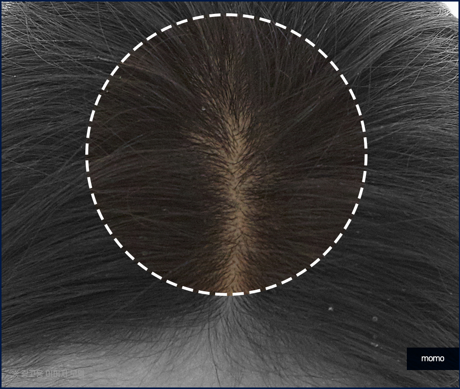 정수리 냄새 제거 원인부터 탁월한 제거 방안까지 관련 이미지 7