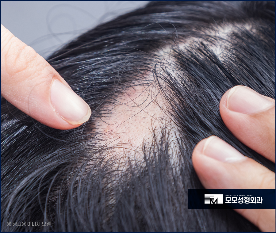 스트레스성탈모증상 다양하게 나뉘어 지는 관련 이미지 4