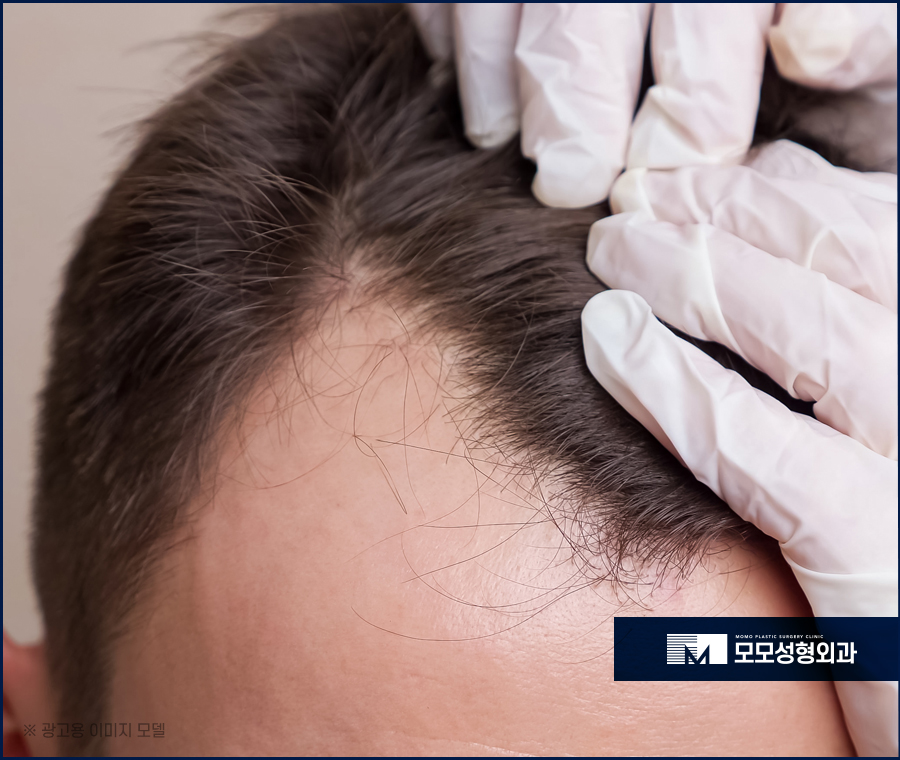 M자탈모병원 깊이 파인 헤어라인이 고민일 경우 관련 이미지 2