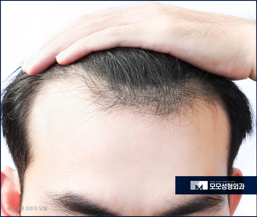 m자탈모병원 근본적인 해결을 위해서 관련 이미지 2