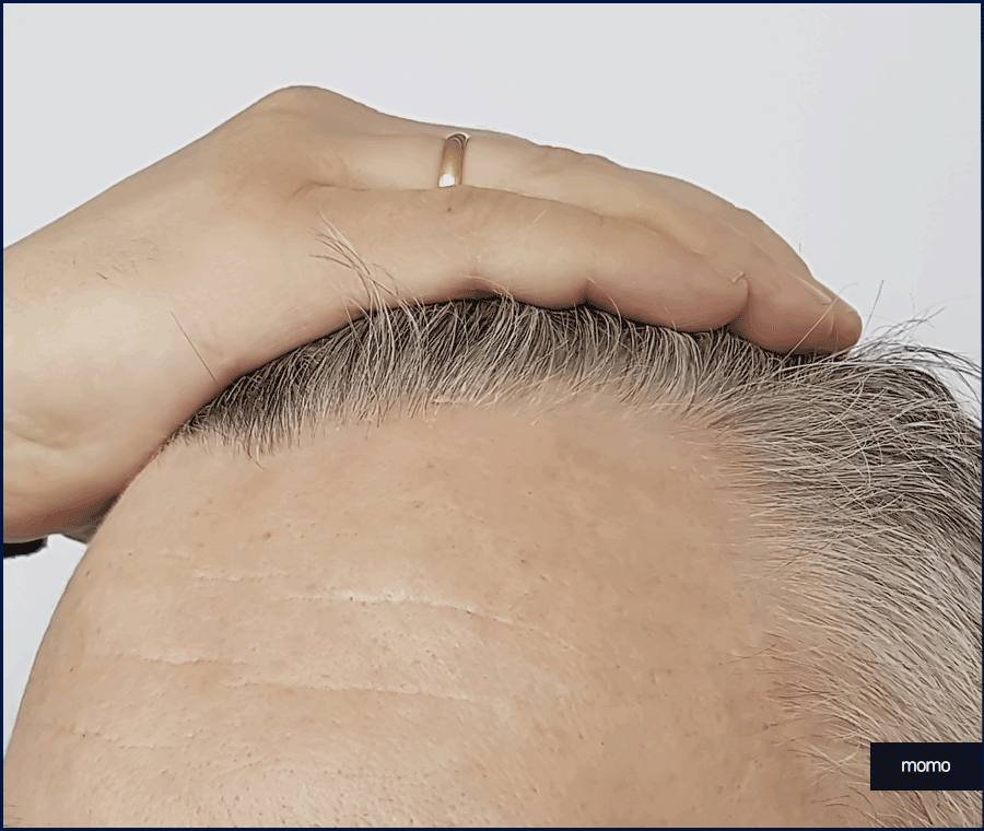 모발이식 생착기간 섬세한 관리가 필요한 이유 관련 이미지 5