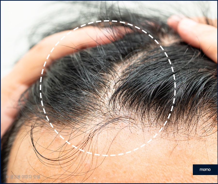 전두부탈모 원인과 시기, 해결 방안까지 관련 이미지 7