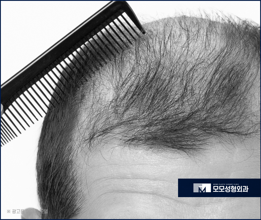 압구정모발이식 당당한 외모 자신감을 위해 관련 이미지 4