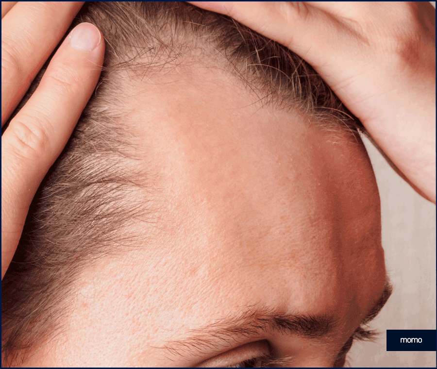 20대 모발이식 성공적인 결과를 위한 필수 조건 관련 이미지 6