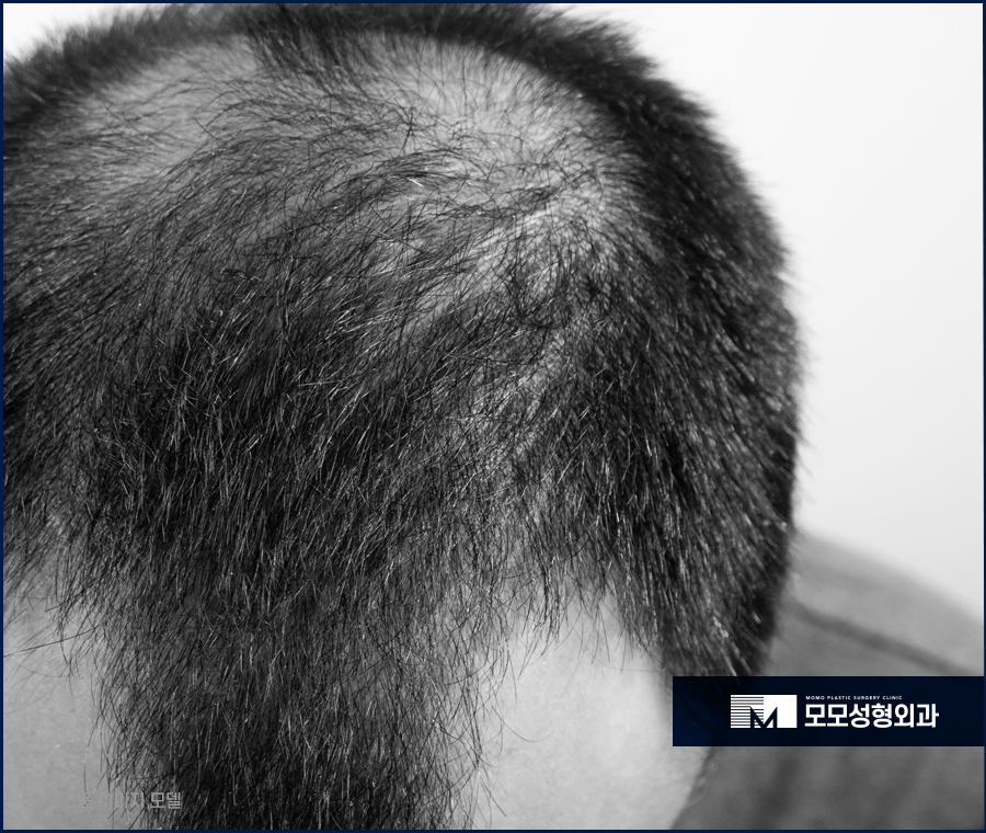 비절개모발이식가격 꼼꼼히 살펴보며 함께 체크할 점 관련 이미지 5
