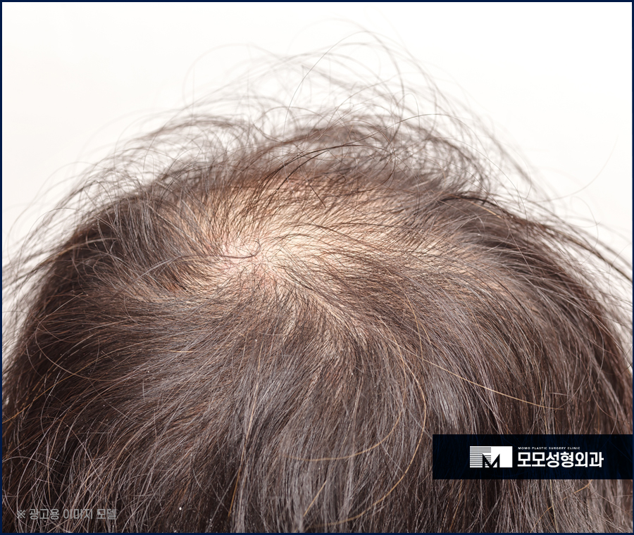 압구정탈모치료 처치 방안을 알아볼 땐 관련 이미지 2