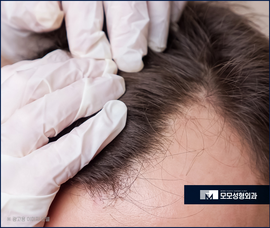 남자 앞머리 탈모 M자 라인 깊어짐이 보인다면 관련 이미지 8