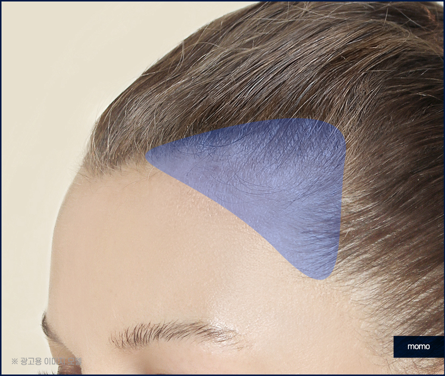 m자탈모초기 빠른 대처를 이뤄낸다면 관련 이미지 8