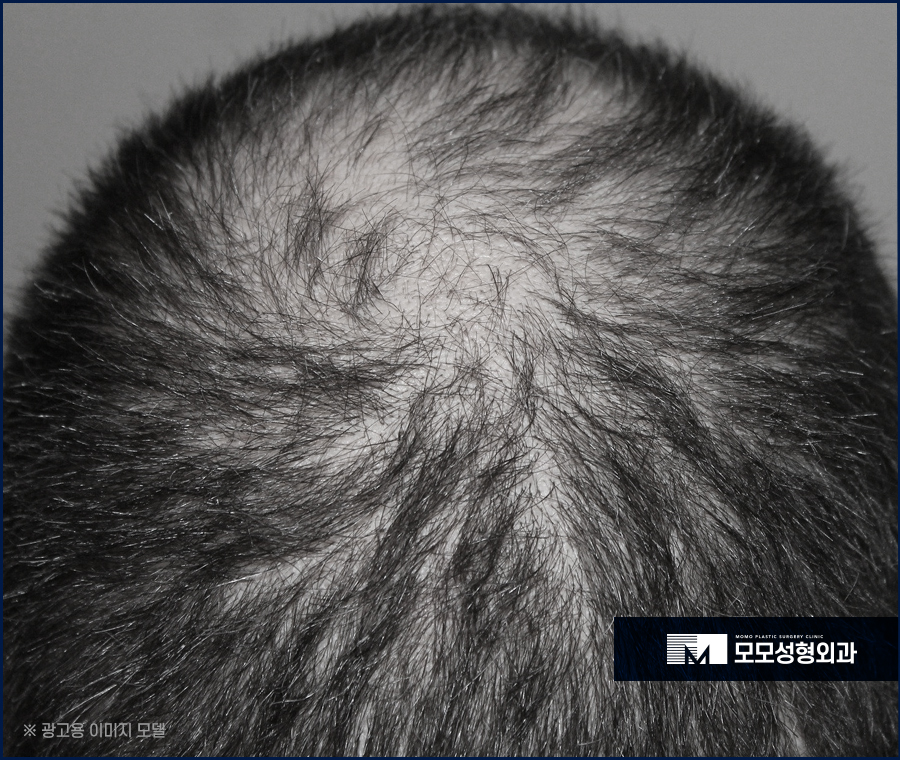 모발이식4000모 양보다 집중해야 하는 부분 관련 이미지 3