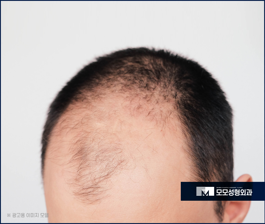 비절개모발이식비용 가격이 아깝지 않은 결과로 관련 이미지 8