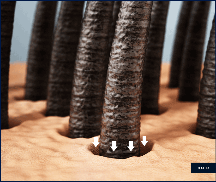 모발이식 2000모 자연스러운 커버 결과 정도는? 관련 이미지 5