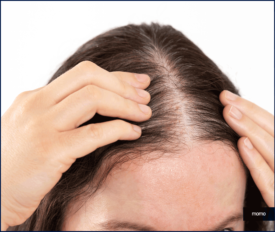 여자 모발이식 헤어라인 교정이 필요하다면 관련 이미지 3