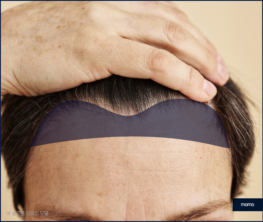 m자 모발이식 가격 달라지게 되는 이유는 관련 이미지 4