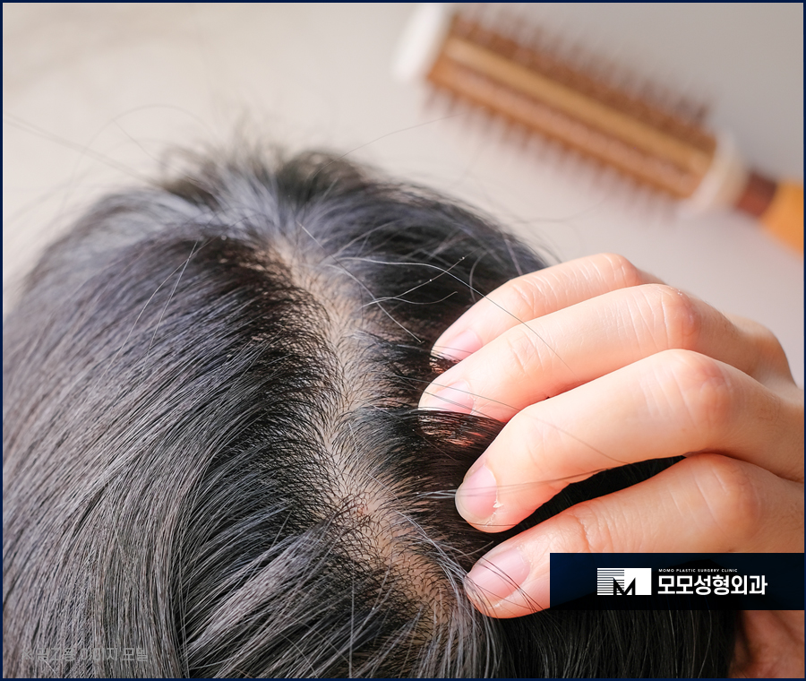 20대정수리탈모초기 신속한 대응이 중요합니다 관련 이미지 2