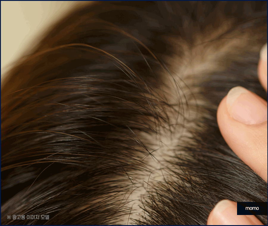 여자 정수리 탈모 초기 증상 및 머리카락빠짐 대응 방안 관련 이미지 5