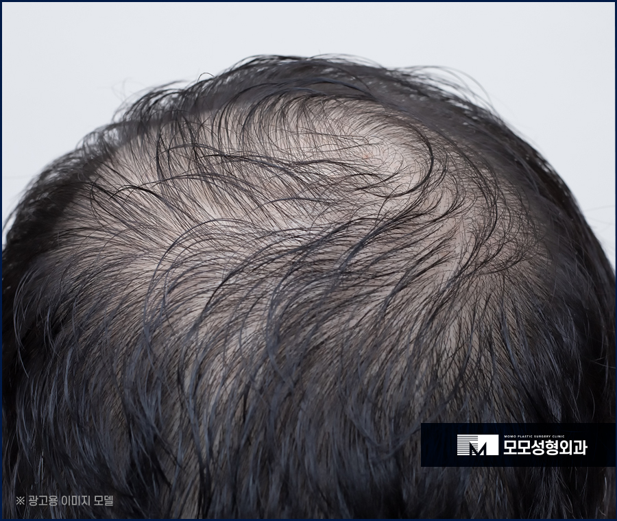 모발이식 3000모 어떤 분들에게 적절할까요 관련 이미지 3