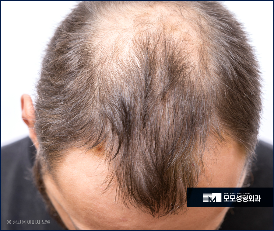 서울탈모병원추천 놀라운 변화로 나아가는 관련 이미지 11