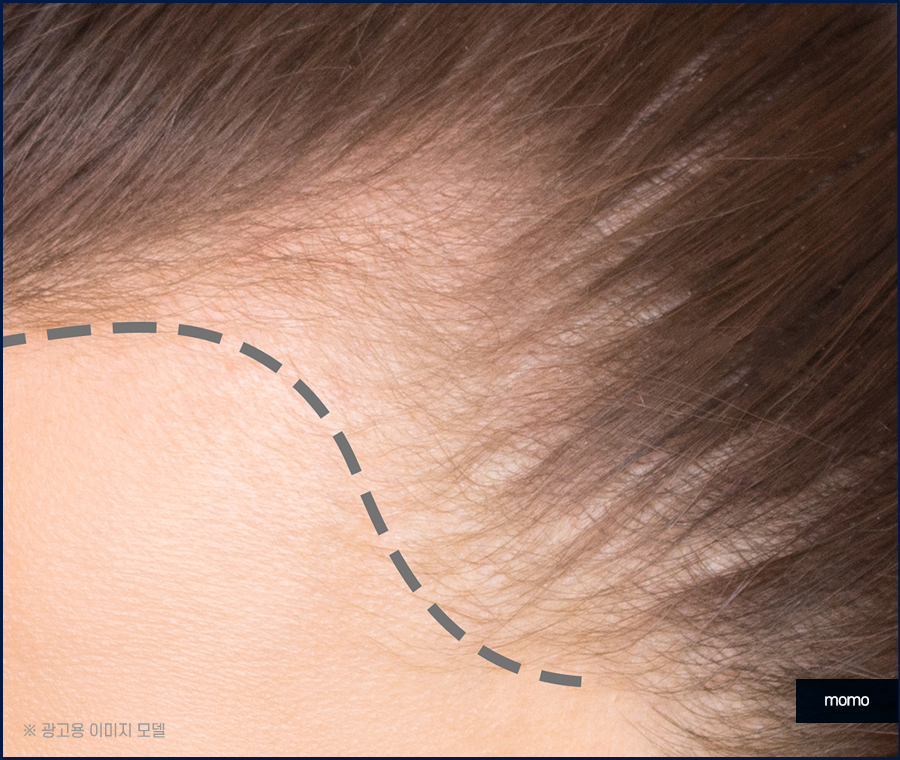 여자 헤어라인 모발이식 외모 자신감을 높이는 관련 이미지 6