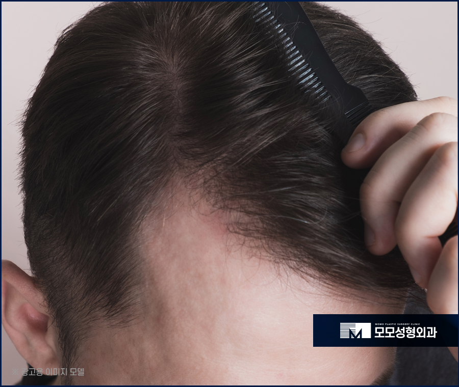 절개모발이식 통증이 걱정스러운 상황이라면 관련 이미지 2